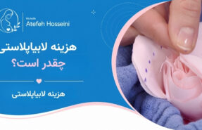 هزینه لابیاپلاستی چقدر است؟